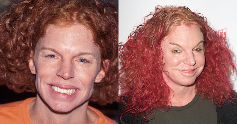 Carrot Top | Plastic Surgery Disasters | Purple Clover