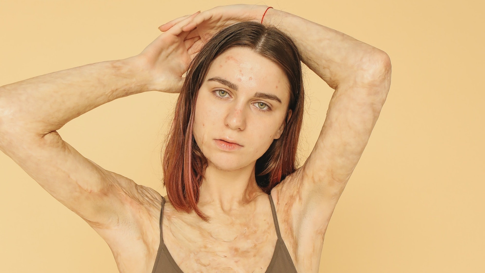 fact-or-fiction-can-i-get-rid-of-burn-scars