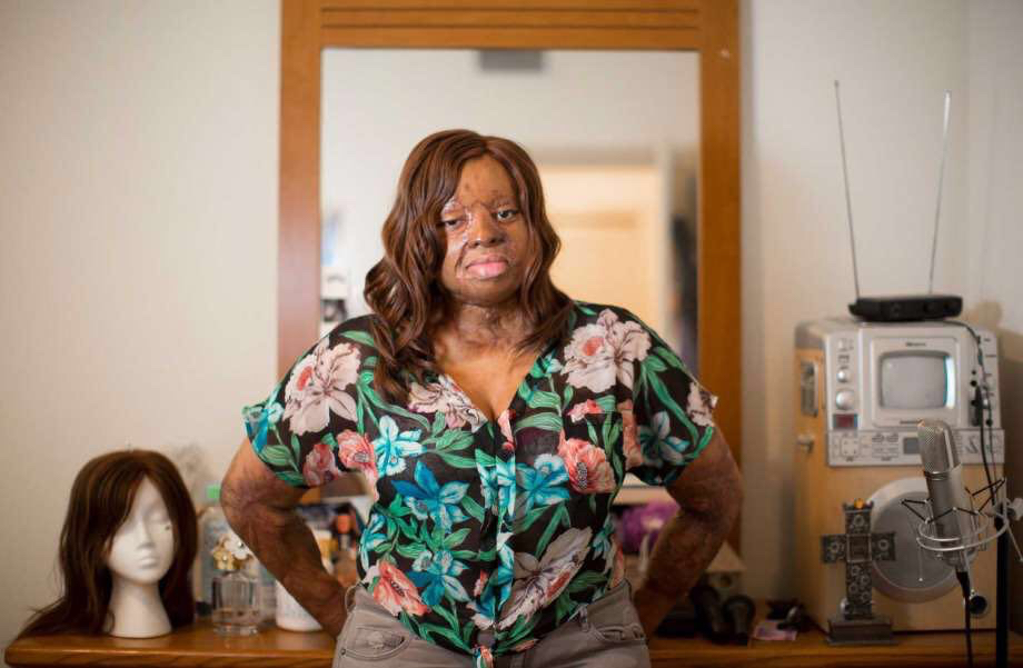 Kechi Okwuchi Burns Are Beautiful