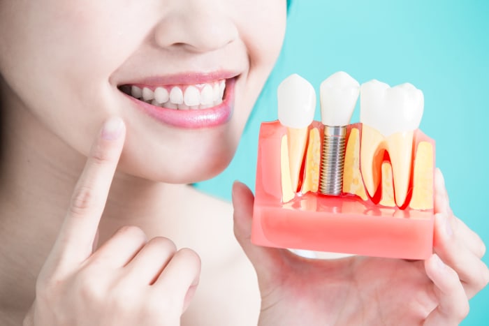 Implantes dentários e Doenças das gengivas: O que necessita saber article banner