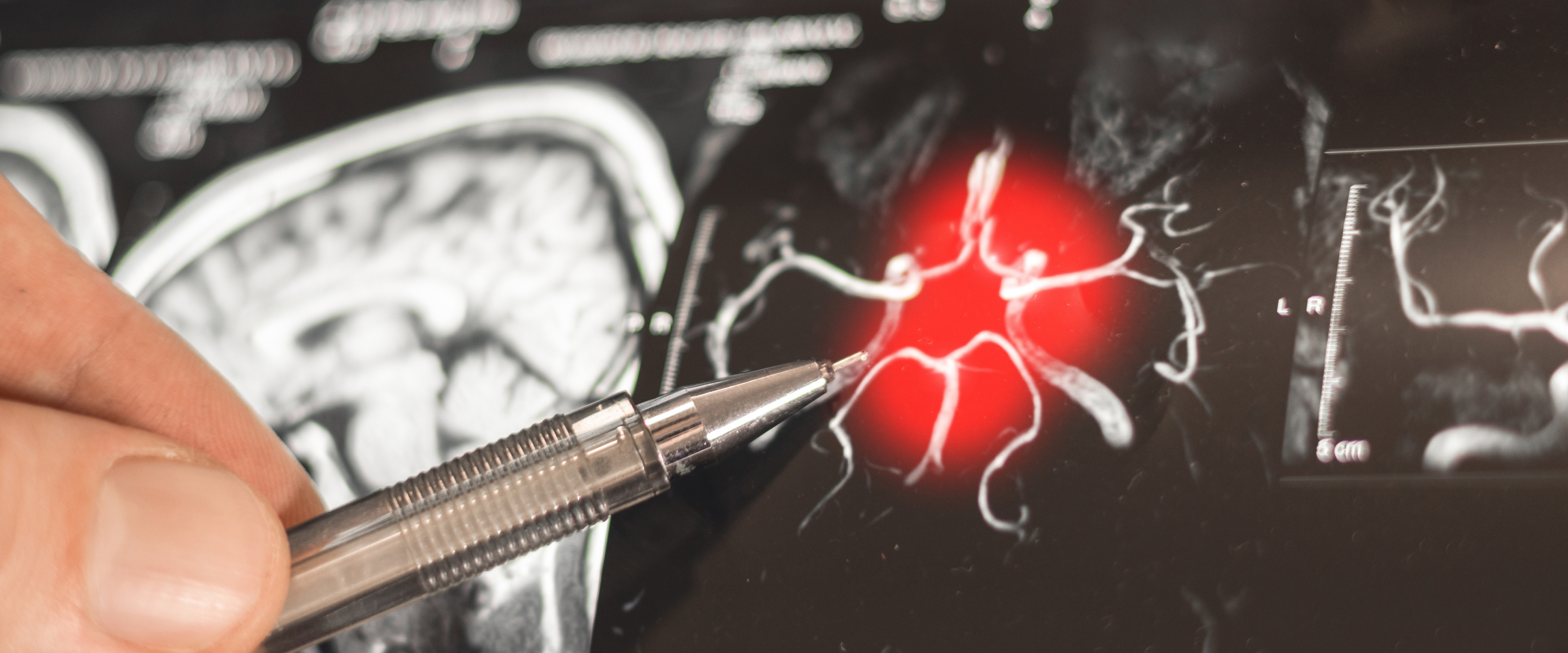 How a Qatar-Led Research Project is Targeting Breakthroughs in Treating Parkinson’s Disease