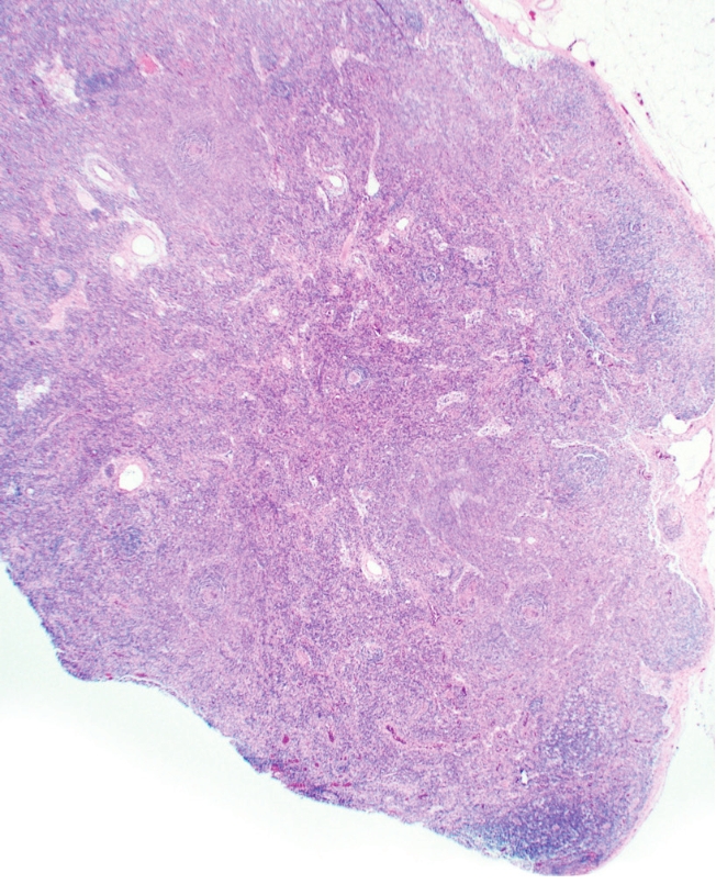 Graphic showing needle core biopsy, also known as incisional biopsy, may not be enough to confirm idiopathic multicentric Castleman disease.