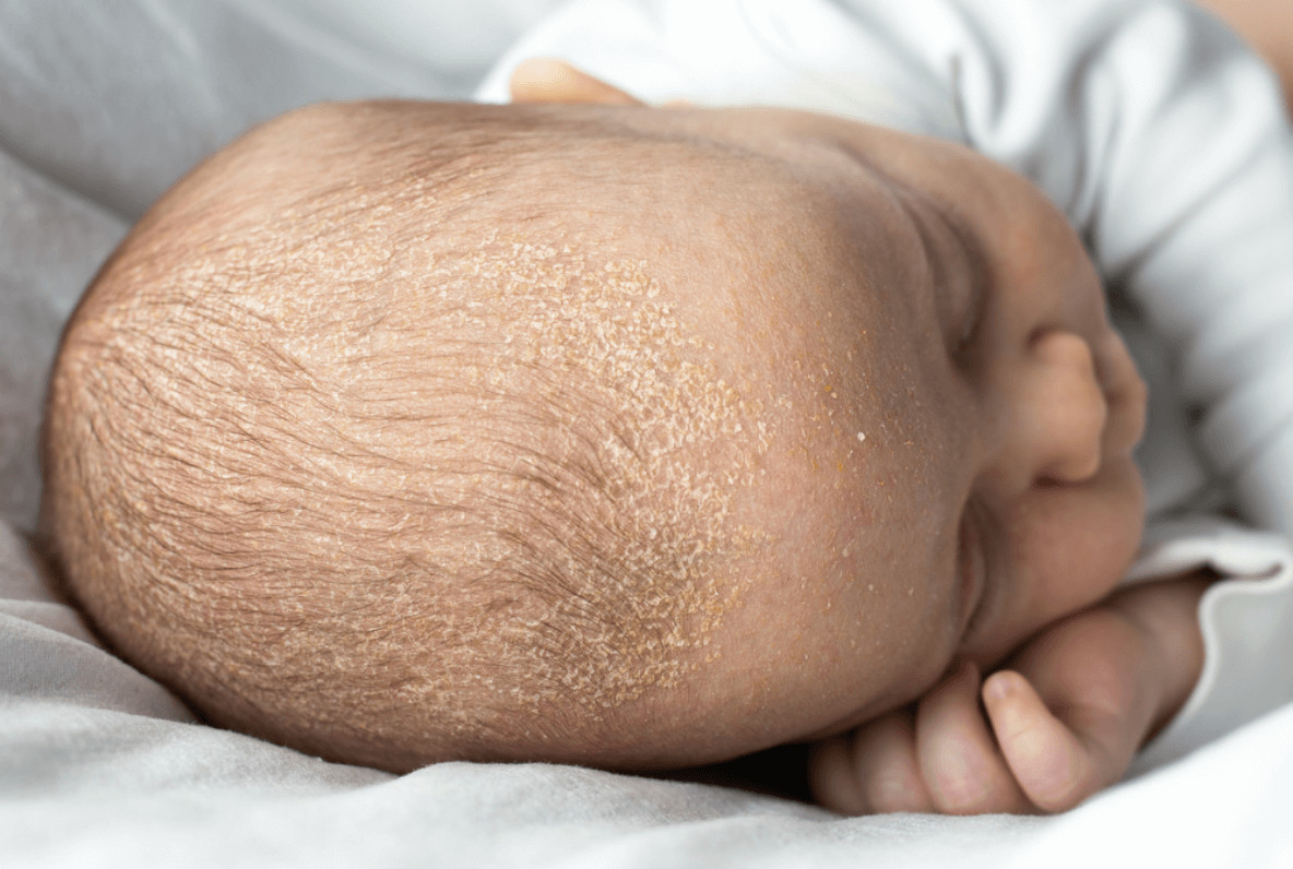 Milchschorf kann bei Babys ein Anzeichen für Dermatitis sein.