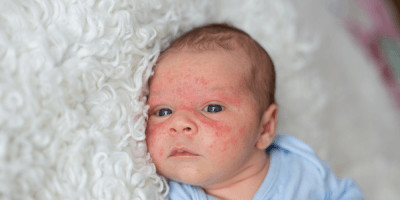 Vor allem im Gesicht kann Neurodermitis für Babys sehr unangenehm sein.