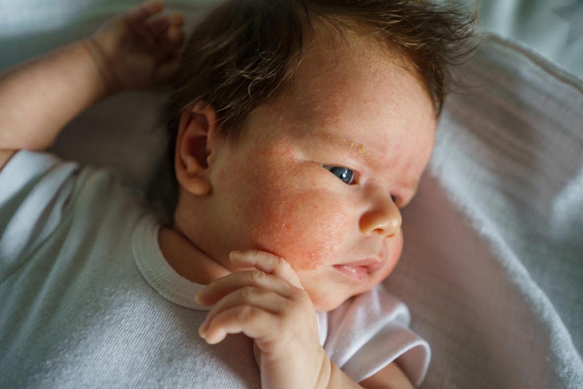 Im Rahmen von Dermatitis bei Babys verändern sich das Hautbild und die -zellen.