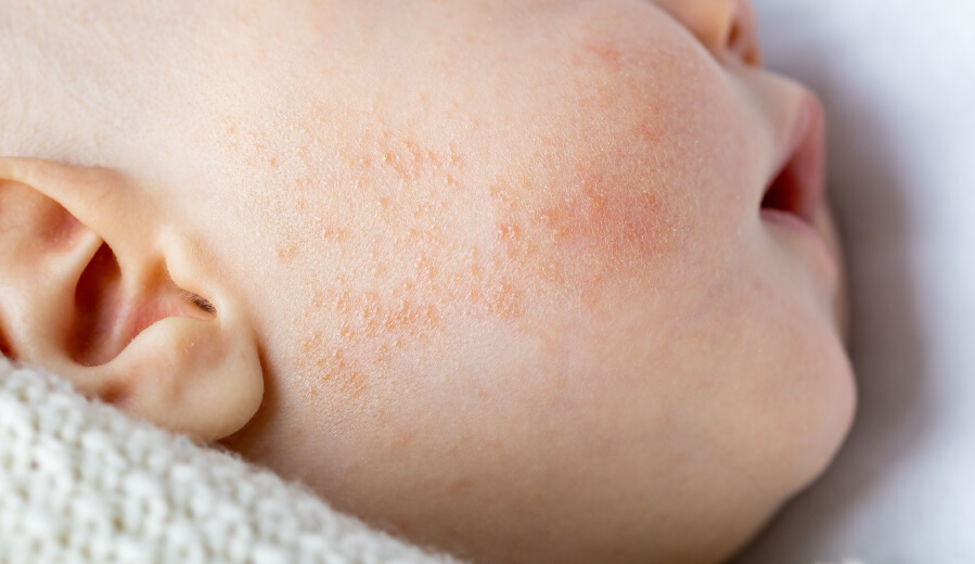 piel-atopica-o-dermatitis-atopica-en-el-bebe-mobile