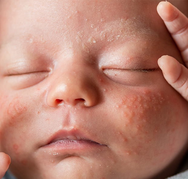 tipos-de-dermatitis-en-bebes-Imagen-desktop