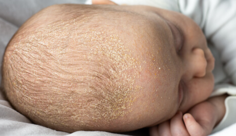 cuidados-para-la-piel-del-recien-nacido-previsualizacion