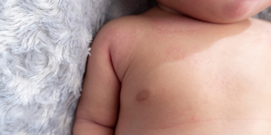 tipos-de-alergias-en-bebes-en-la-piel-interna01