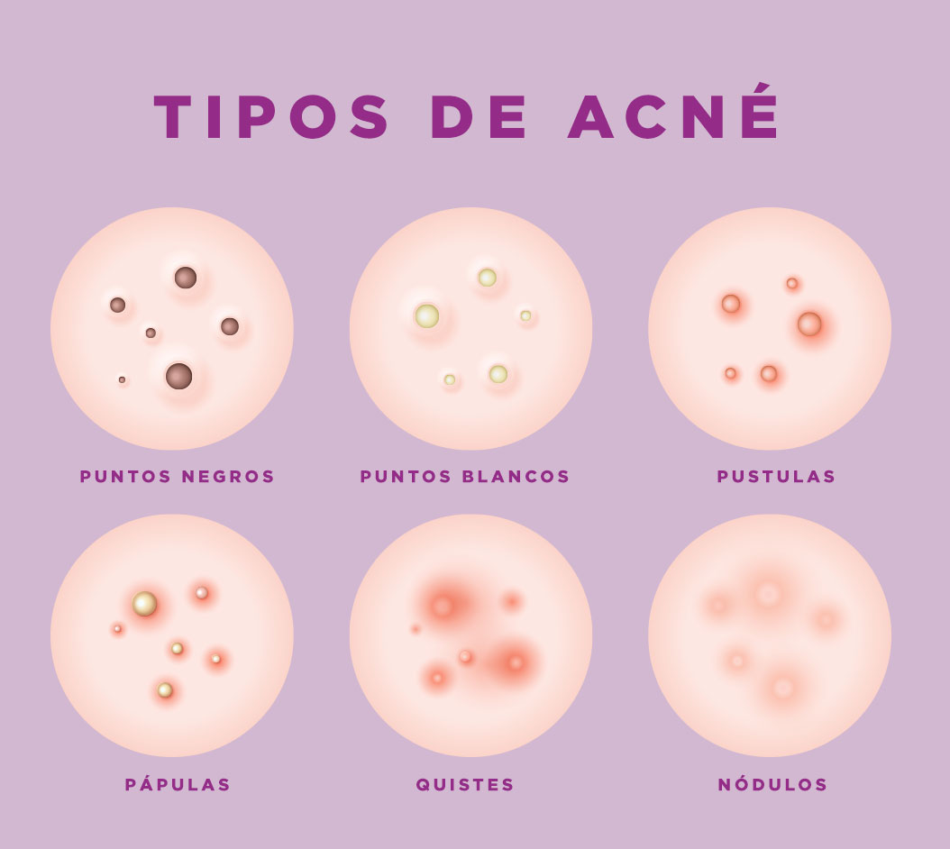 acné