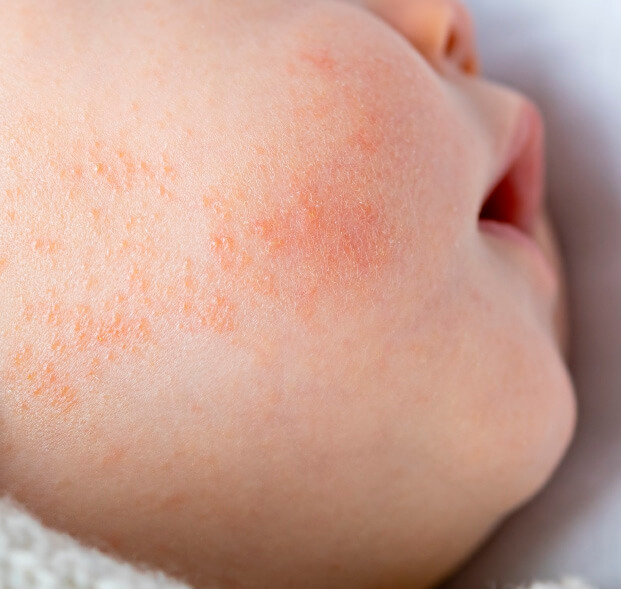 piel-atopica-en-bebes-desktop