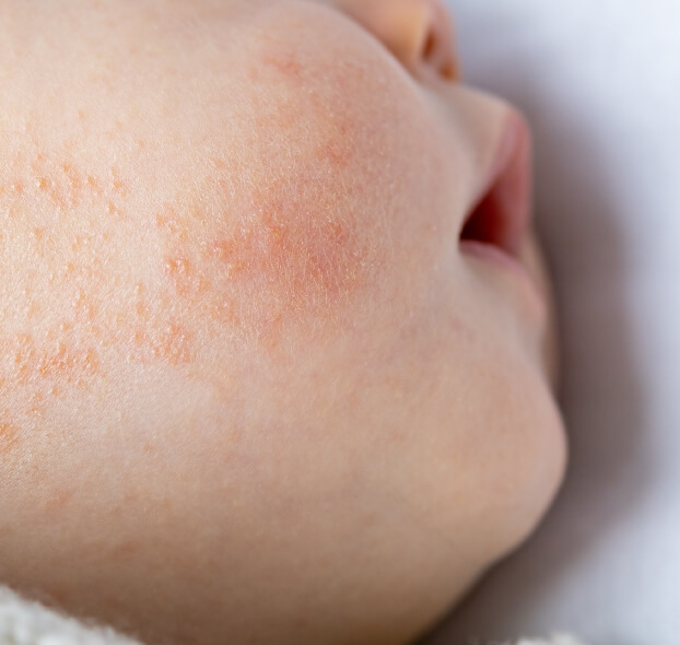 piel-atopica-o-dermatitis-atopica-en-el-bebe-desktop