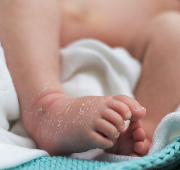 descamacion-en-la-piel-del-bebe-es-normal-desktop