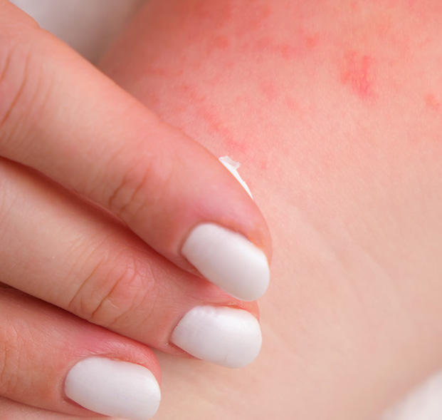 Hongos-tipos-dermatitis en-bebes-Ecuador-Imagen desktop