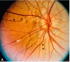 Angioid streaks