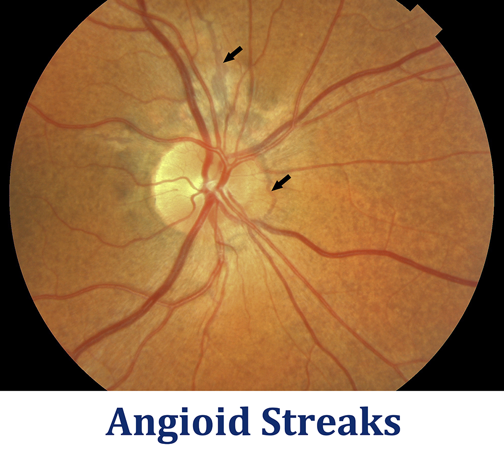 Figure 3: Angioid Streaks