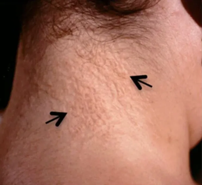 Papules