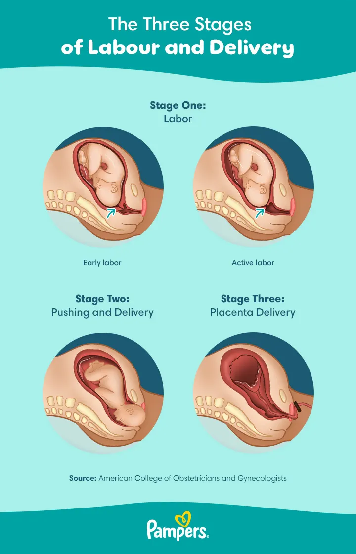 The three stages of labour and delivery