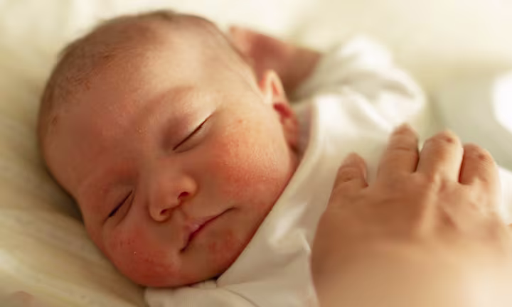 Ekzeme und trockene Haut bei Babys