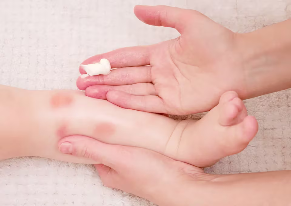 Bebé con dermatitis atópica