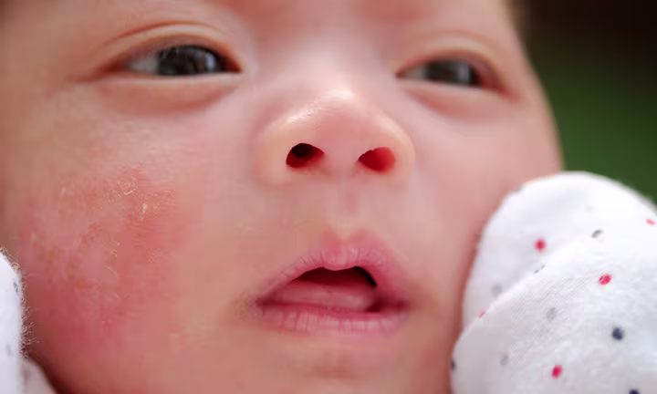 baby acne on face
