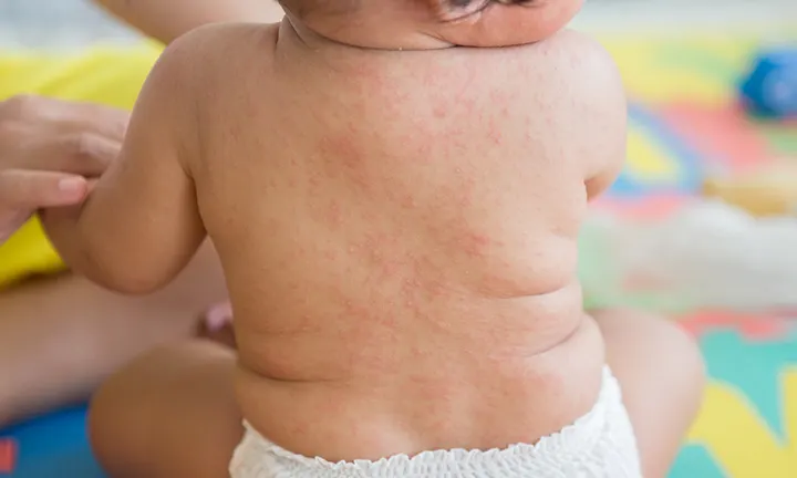 Roseola rash Roseola rash