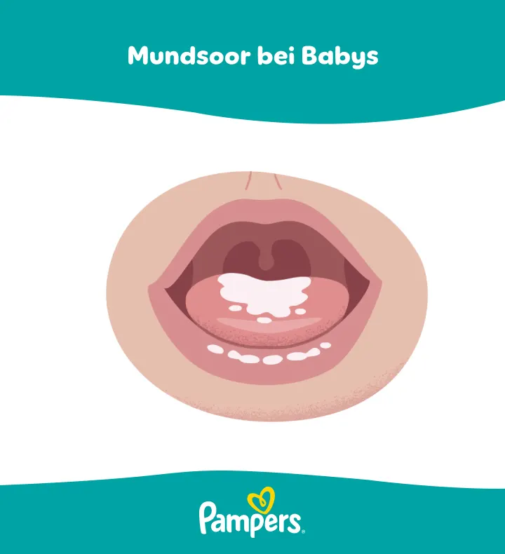 Mundsoor im Mund eines Babys Mundsoor im Mund eines Babys