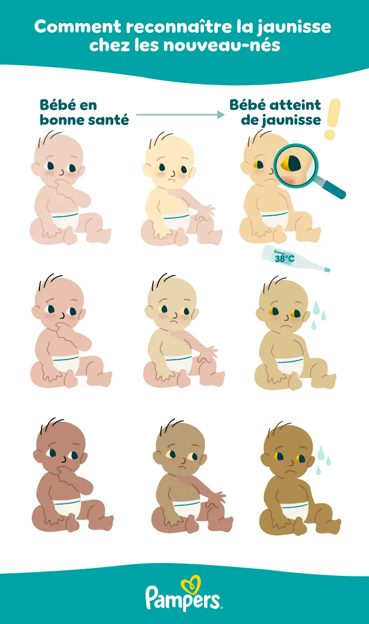 Pour vous aider à identifier plus facilement si votre bébé a une jaunisse, voici quelques exemples avec différentes colorations de peau.