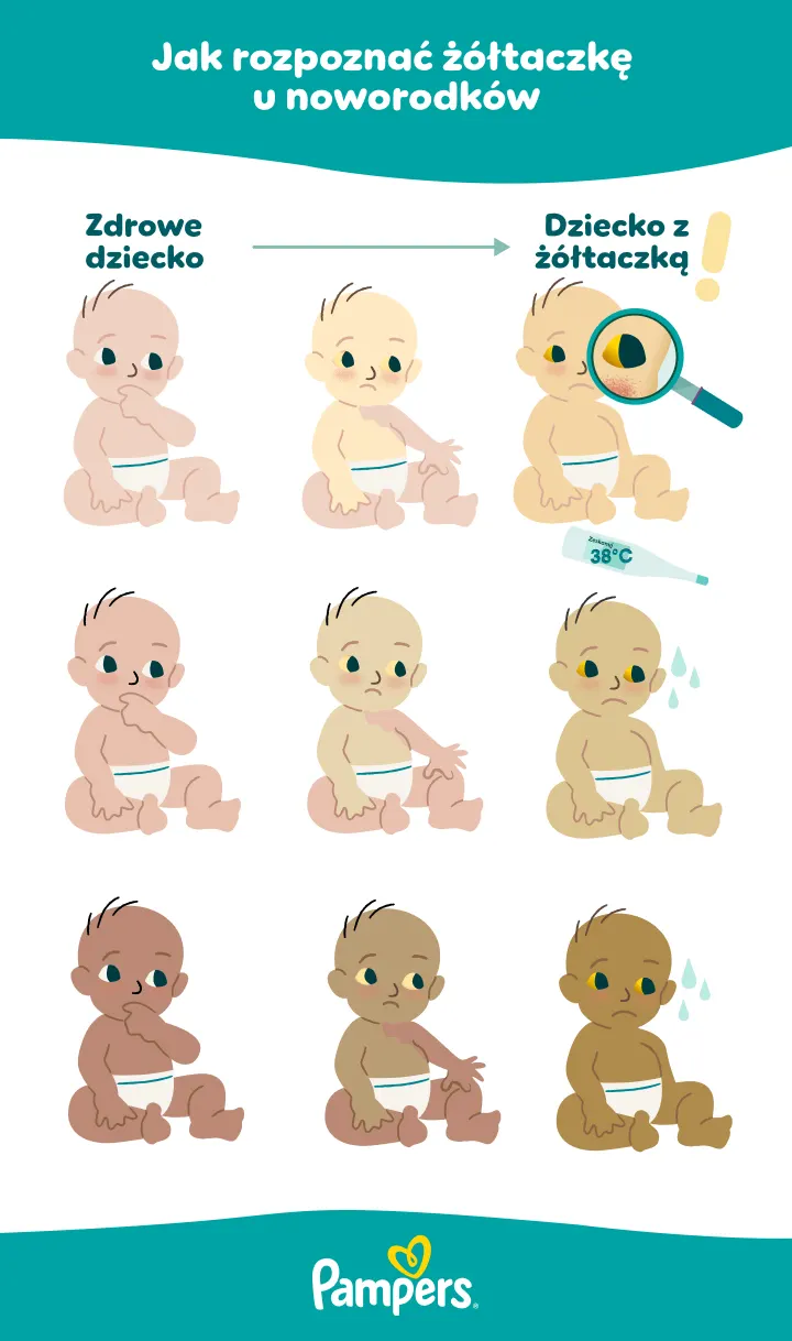 Ilustracja przedstawiająca różne odcienie skóry noworodków z objawami żółtaczki, ułatwiająca ich identyfikację. Ilustracja przedstawiająca różne odcienie skóry noworodków z objawami żółtaczki, ułatwiająca ich identyfikację.