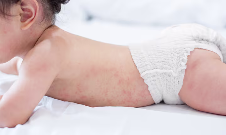 Bouton et rougeurs sur un bébé