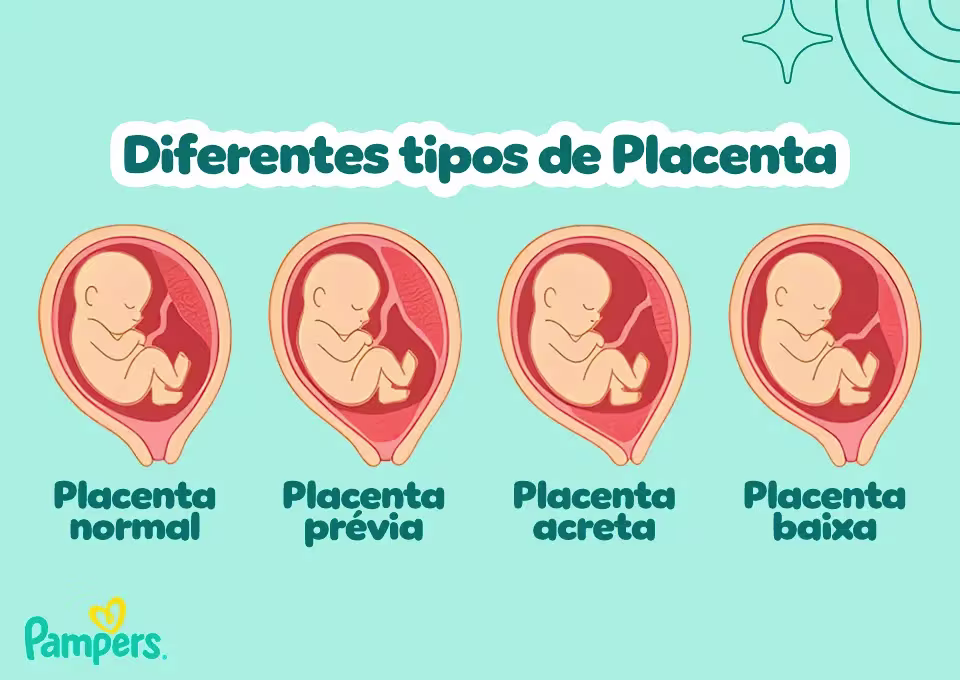 Diferentes tipos de Placenta Tipos de placenta