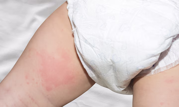 Close-up of a baby’s skin showing red, irritated nappy rash around the nappy area.