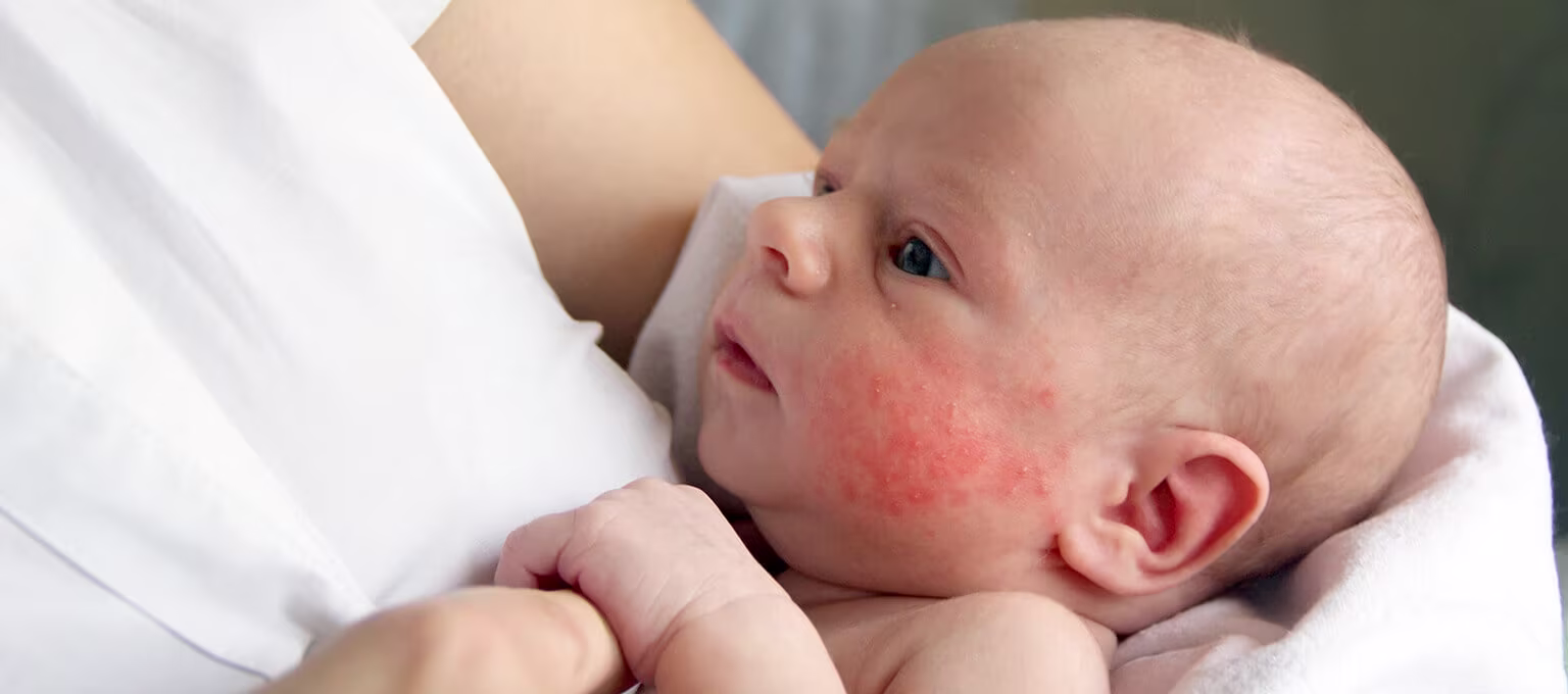 Baby suffering from eczema