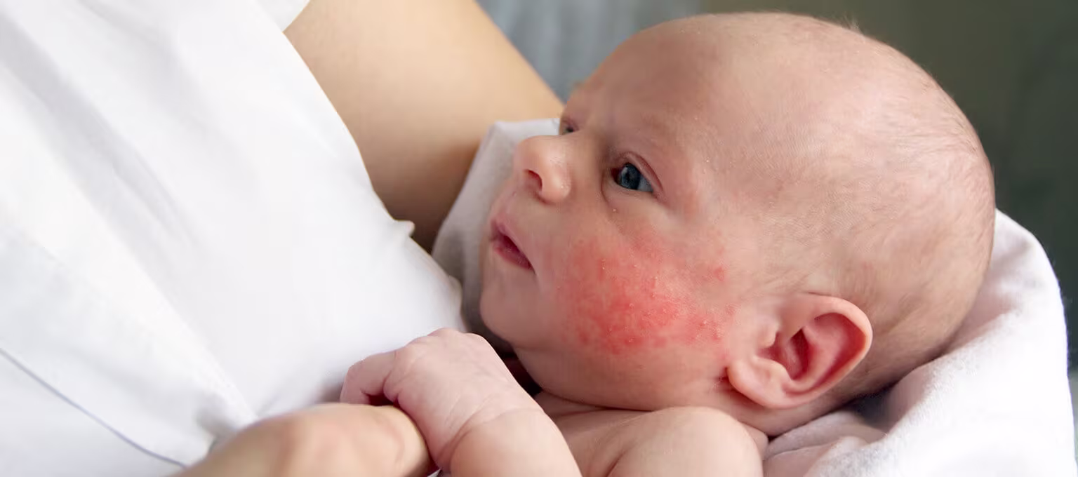Baby suffering from eczema