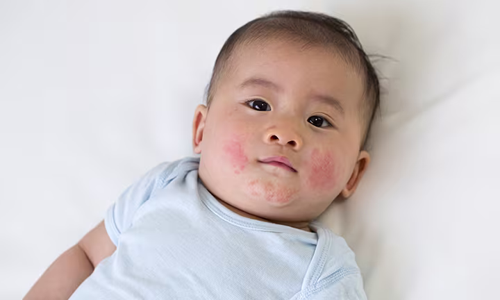 Fifth disease rash