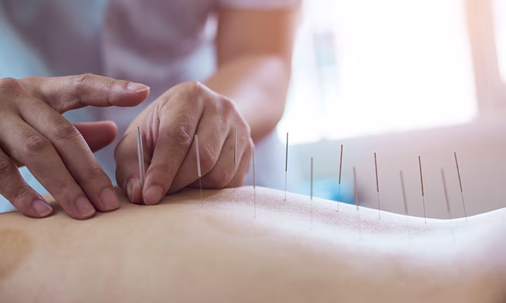 Akupunktur in der Schwangerschaft