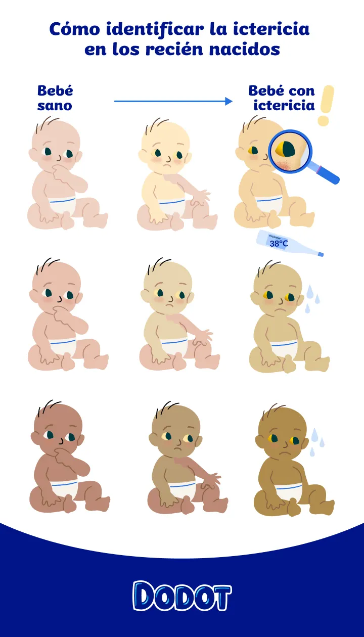 Ilustración que muestra signos visuales de ictericia en recién nacidos con distintos tonos de piel para facilitar la identificación de un bebé con ictericia.