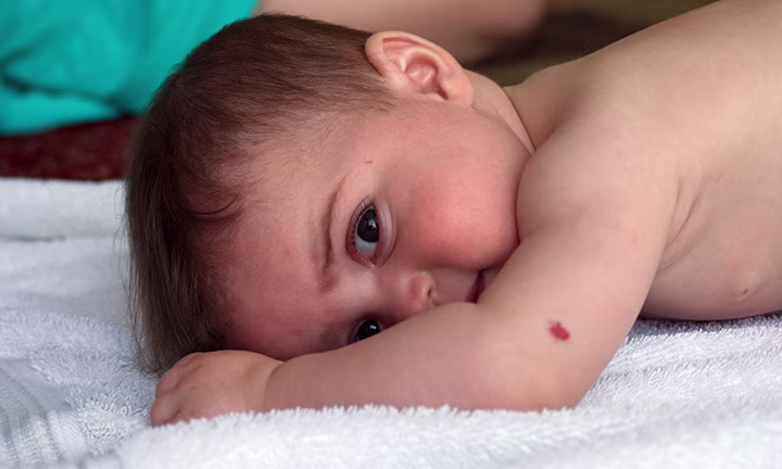 Tache de naissance sur un bébé