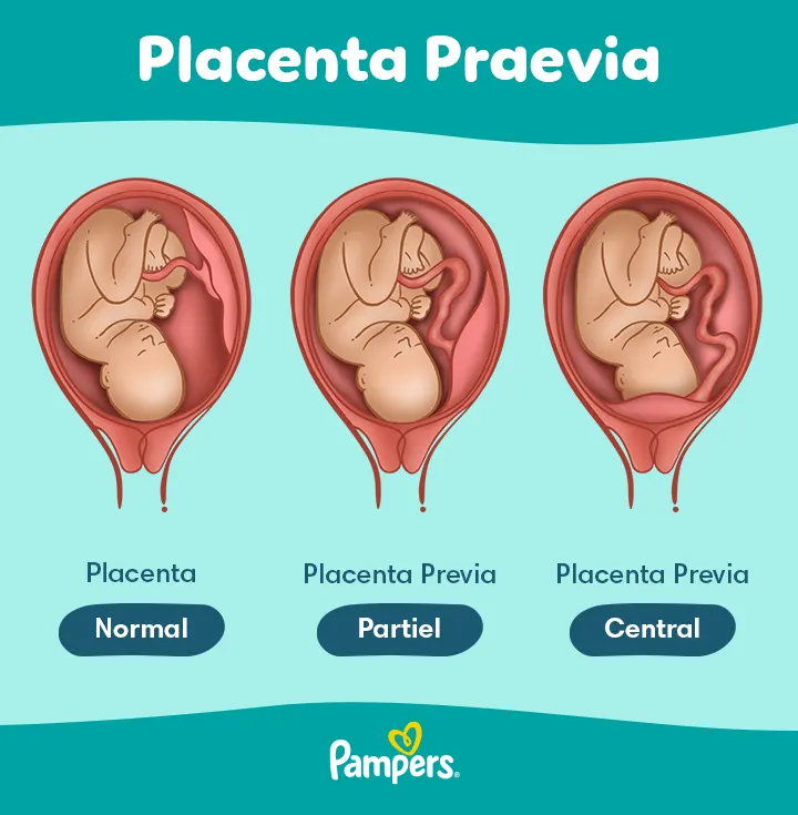 Les différents types de placenta prævia