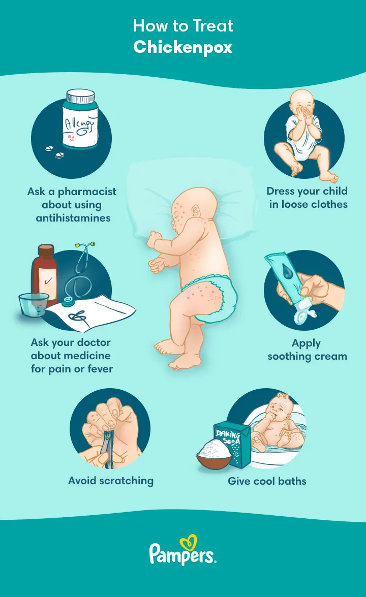 How to Treat Chickenpox How to Treat Chickenpox