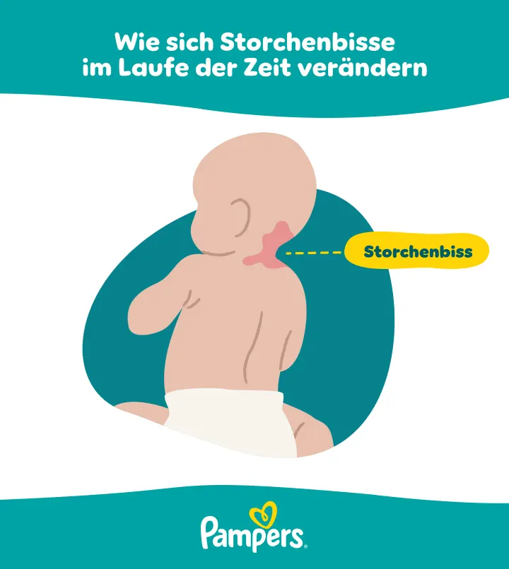 Wie sich Storchenbisse im Laufe der Zeit verändern