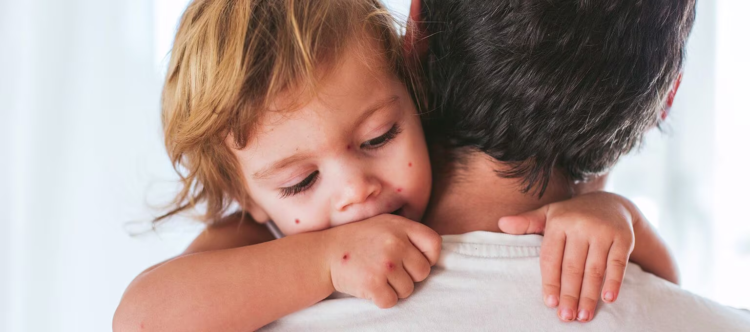 Chicken Pox in Babies and Toddlers