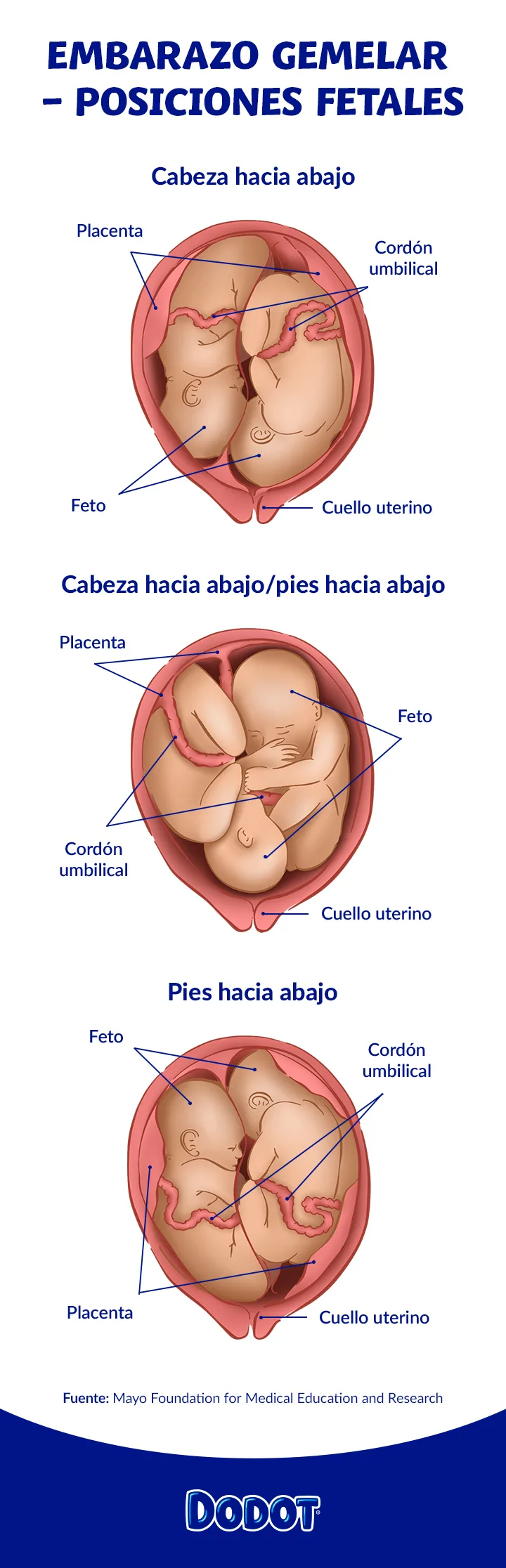 Tipos de gemelos Tipos de gemelos
