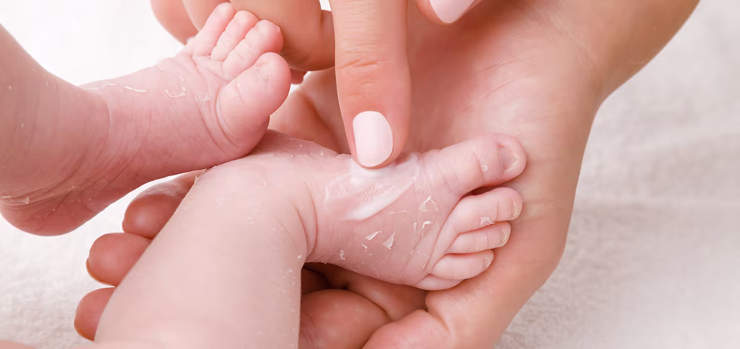 Newborn skin peeling