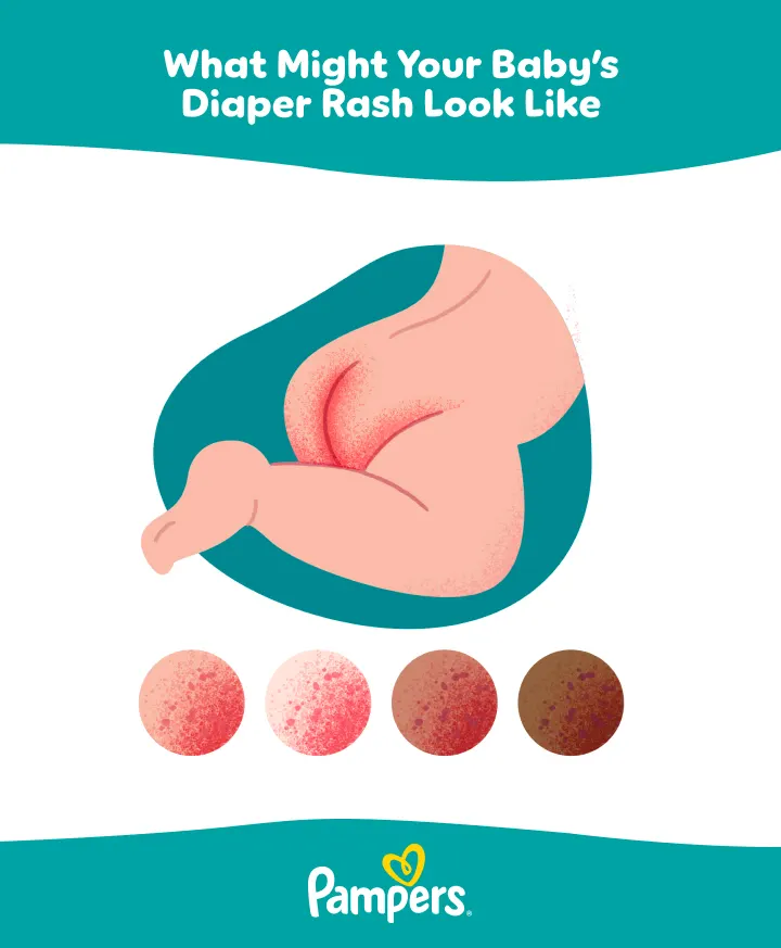 How does diaper rash look like 