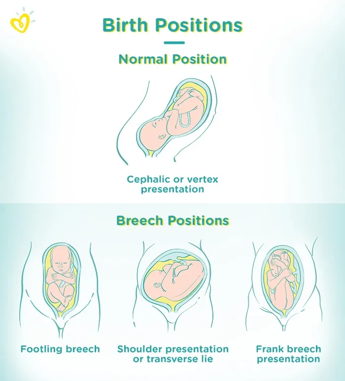Breech presentation