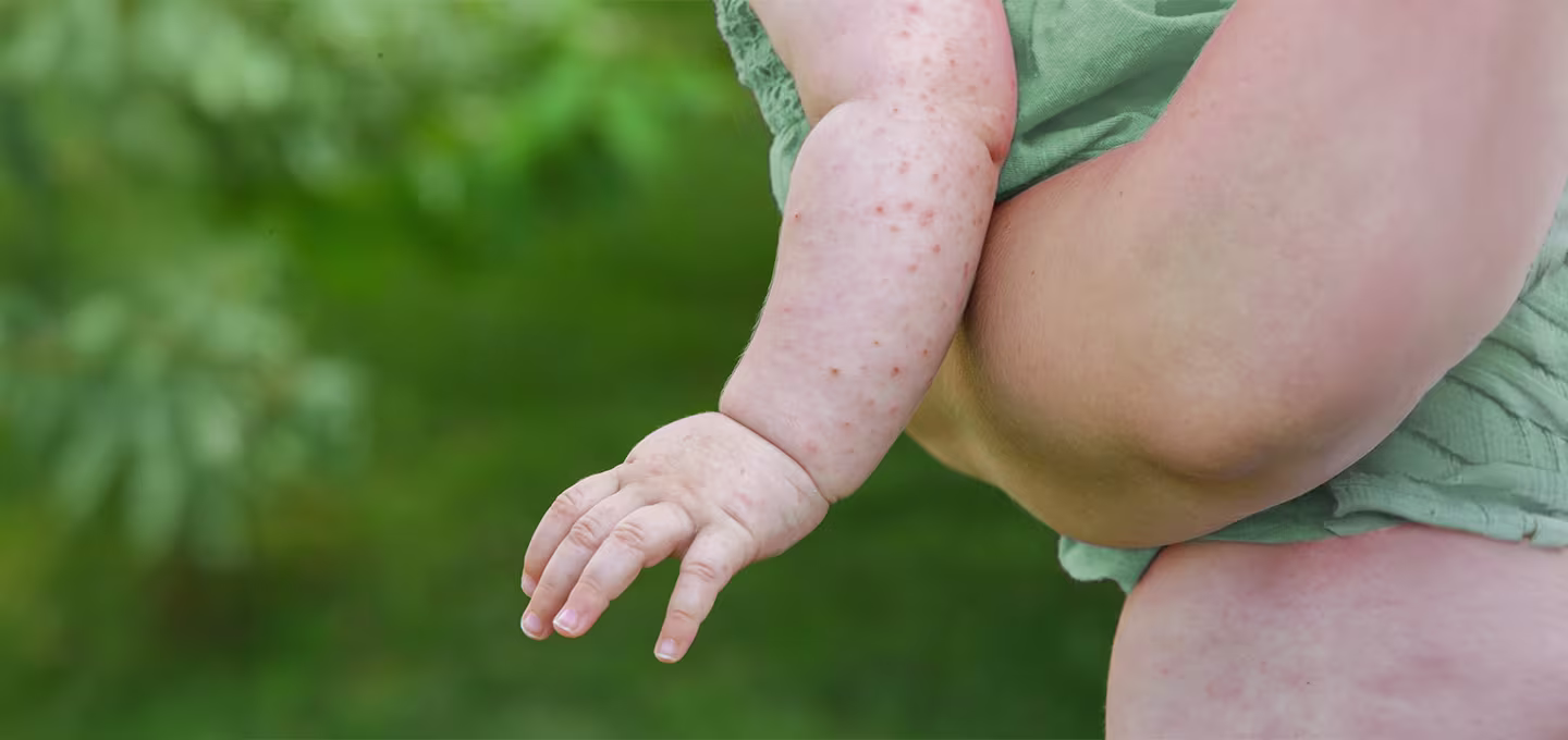 Gros plan sur le bras d’un bébé présentant une éruption cutanée liée à la chaleur.