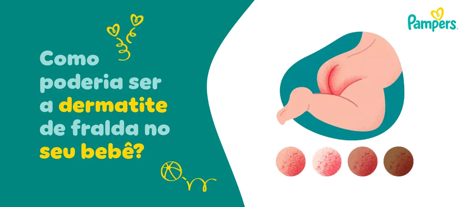 Como poderia ser a dermatite de fralda no seu bebê?