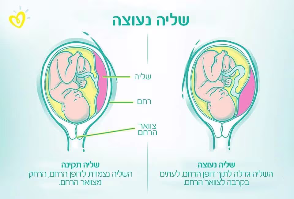 שליה נעוצה-Article Content Image infographic שליה נעוצה