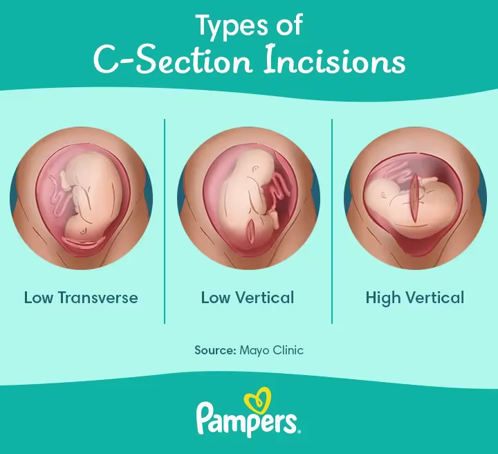 C-Section scar